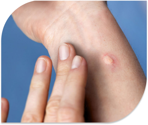 Mckenstich am Handgelenk