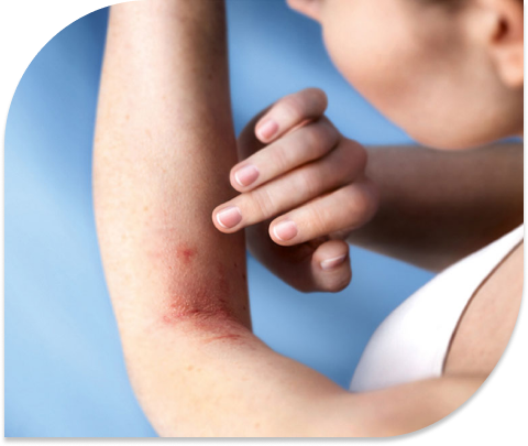 Ausschlag in der Ellenbeuge